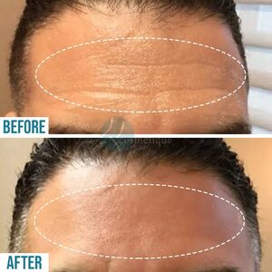 forehead line Botox before and after, forehead line Botox Treatment in Lahore, forehead line Botox Treatment in Pakistan