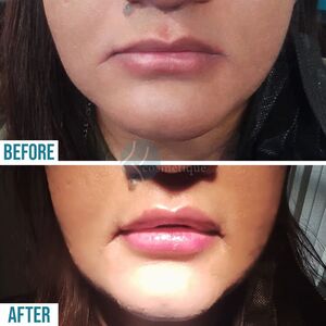 Lip fillers treatment in Lahore, Lip fillers treatment in Pakistan