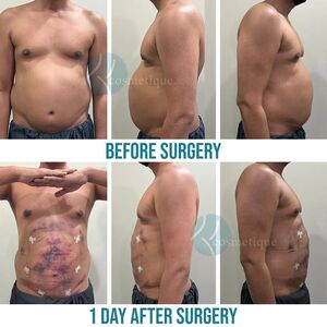 liposuction surgery after 1 day, liposuction surgery in lahore after 1 day