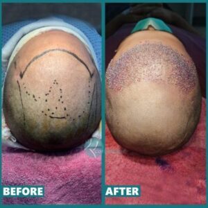 before and after hair transplant , cosmetique hair transplant before and after
