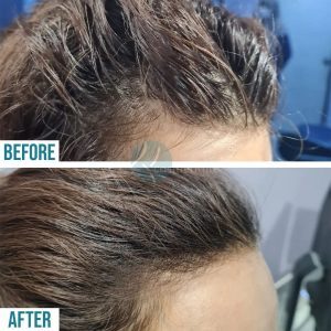 PRP For Hair Loss Treatment before and after, PRP For Hair Loss Treatment in Lahore, PRP For Hair Loss Treatment in Pakistan