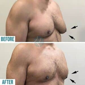 Male Breast Reduction Using tumescent liposuction Treatment in Lahore, Male Breast Reduction Using tumescent liposuction in Paksitan