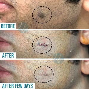 Mole Removal Through Surgical Excision, Mole Removal Through Surgical Excision in Lahor,k Mole Removal Through Surgical Excision in Pakistan