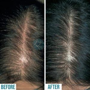 before and after hair loss treatment in lahore