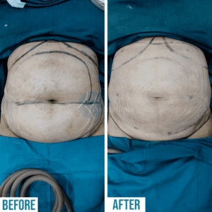 liposuction before afterpictures after 4 week ,