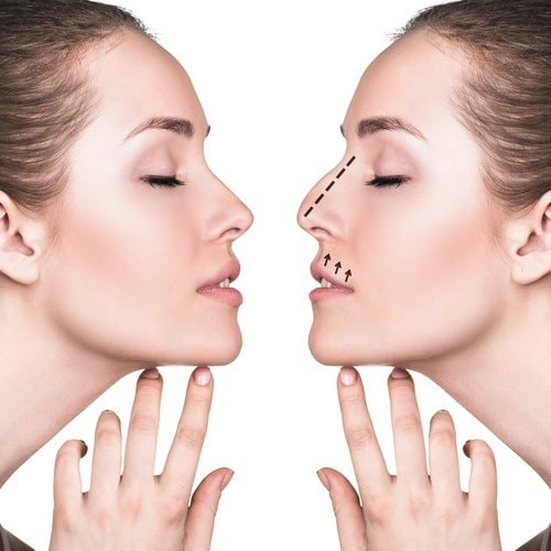 Rhinoplasty Surgery treatment In Lahore, Rhinoplasty Surgery treatment In Pakistan