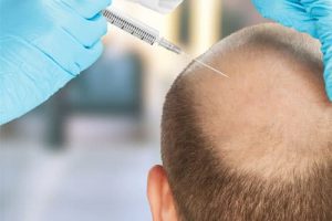 Hair Transplant in lahore , Hair Transplant solution in Pakistan